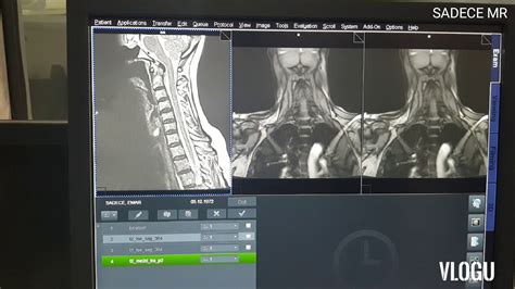 servikal vertebra mr nasıl çekilir